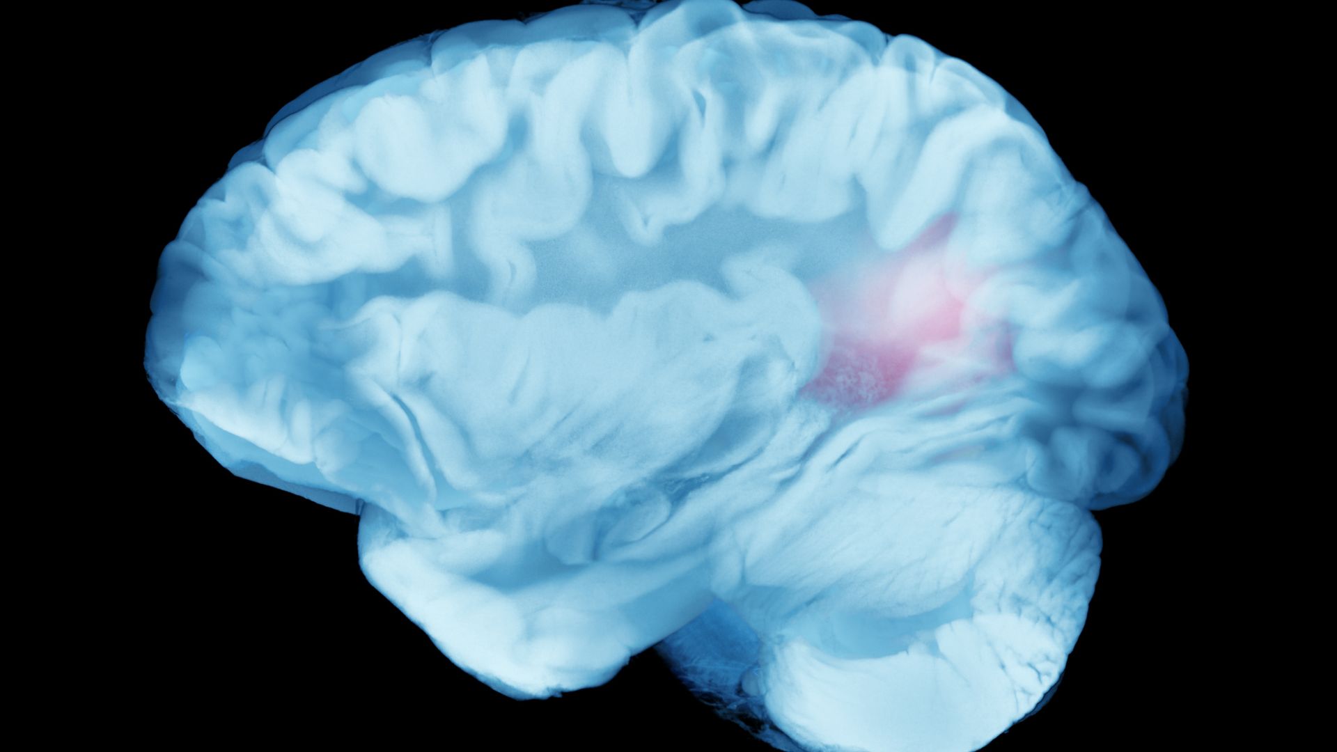 Die Abbildung eines Gehirns mit einem Schlaganfall