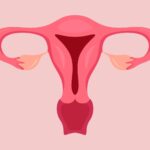 Herausforderungen und Perspektiven in der Behandlung von symptomatischen Uterusmyomen