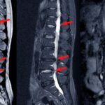 Operative Eingriffe bei einer Spinalkanalstenose der Lendenwirbelsäule